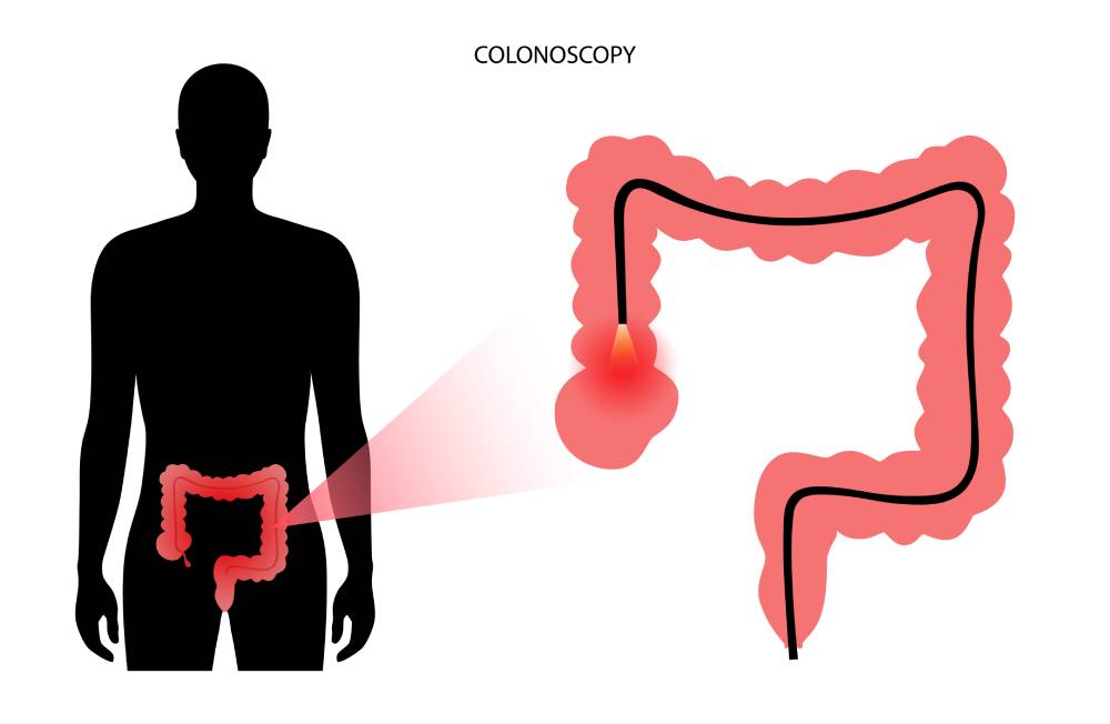 Colonoscopia con el Dr. Tapia: Exploración Detallada del Colon