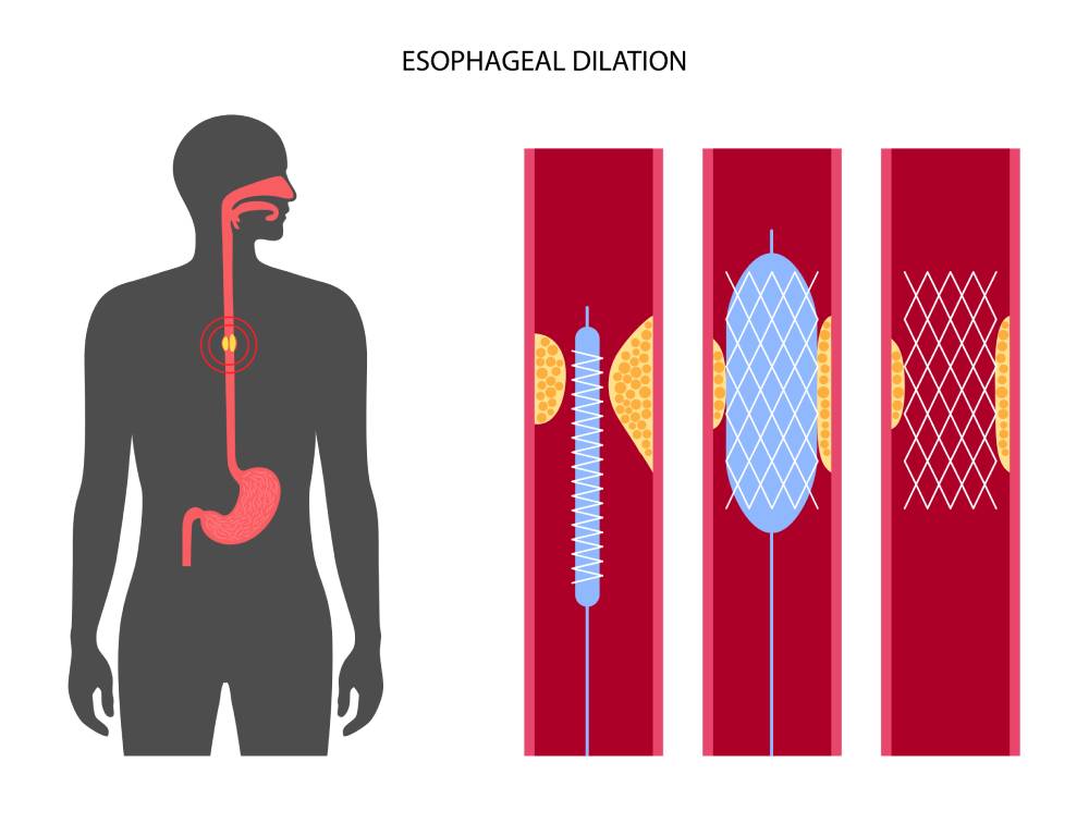 Dilatación Esofágica con el Dr. Tapia: Tratamiento para la Estenosis Esofágica