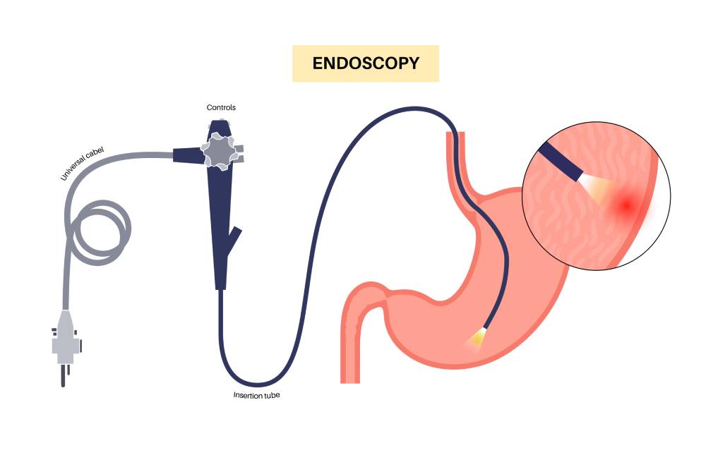 Endoscopia Gastrointestinal con el Dr. Tapia: Exploración Completa del Tracto Digestivo