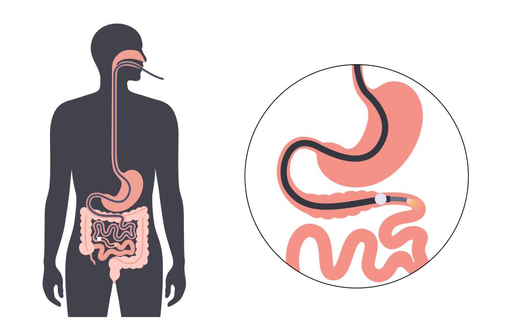 Enteroscopia con el Dr. Tapia: Evaluación Completa del Intestino delgado
